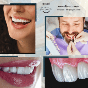 Lamine Diş Kaplama Laminate Veneers Dişyeri Grup