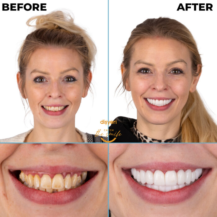 diş tedavisi dişyeri grup mecidiyeköy gülüş tasarımı implant zirkonyum-1