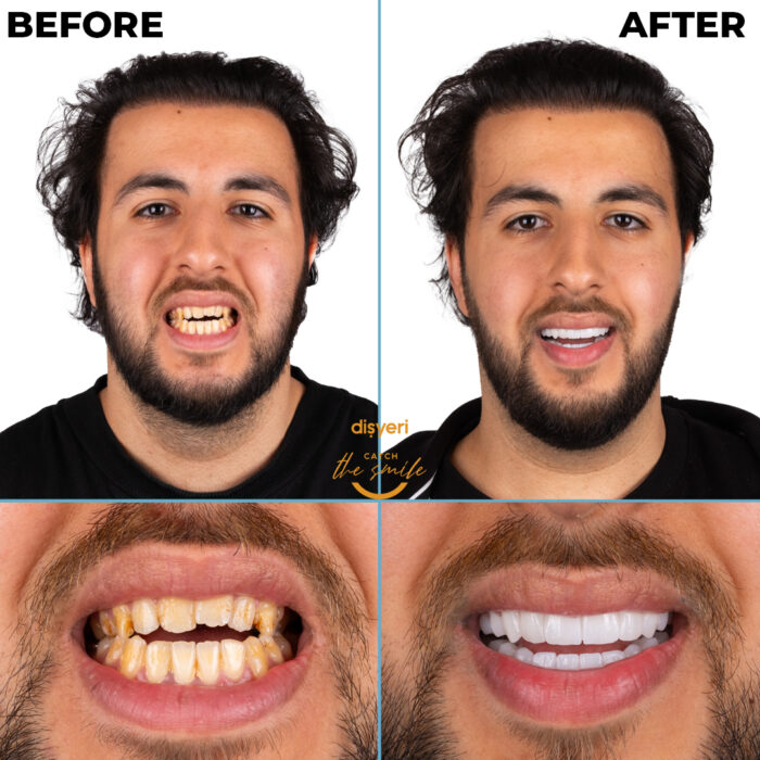 diş tedavisi dişyeri grup mecidiyeköy gülüş tasarımı implant zirkonyum-10