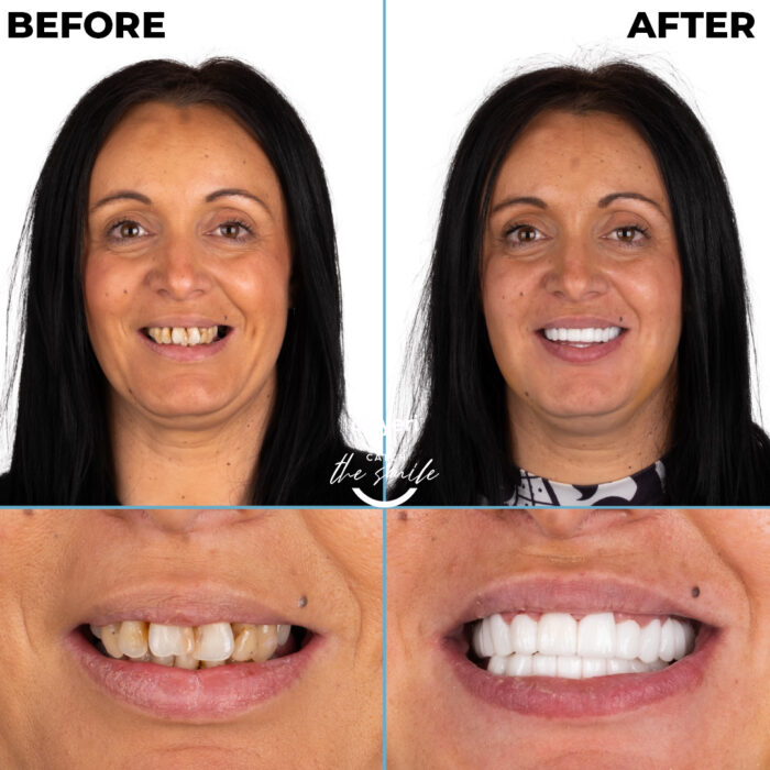 diş tedavisi dişyeri grup mecidiyeköy gülüş tasarımı implant zirkonyum-11