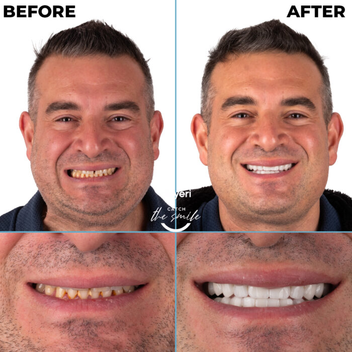 diş tedavisi dişyeri grup mecidiyeköy gülüş tasarımı implant zirkonyum-12