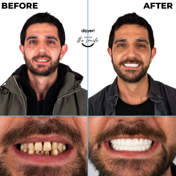 diş tedavisi dişyeri grup mecidiyeköy gülüş tasarımı implant zirkonyum-13