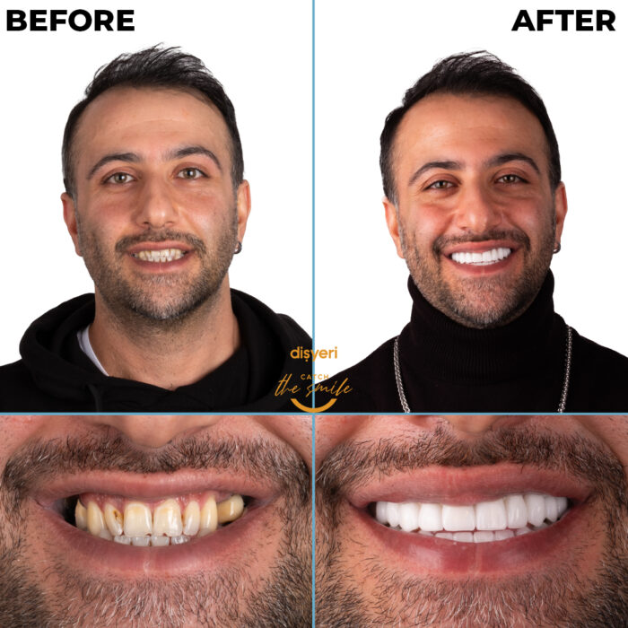 diş tedavisi dişyeri grup mecidiyeköy gülüş tasarımı implant zirkonyum-2