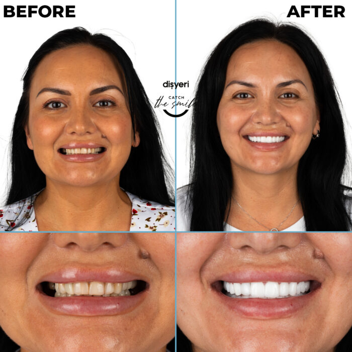 diş tedavisi dişyeri grup mecidiyeköy gülüş tasarımı implant zirkonyum-3