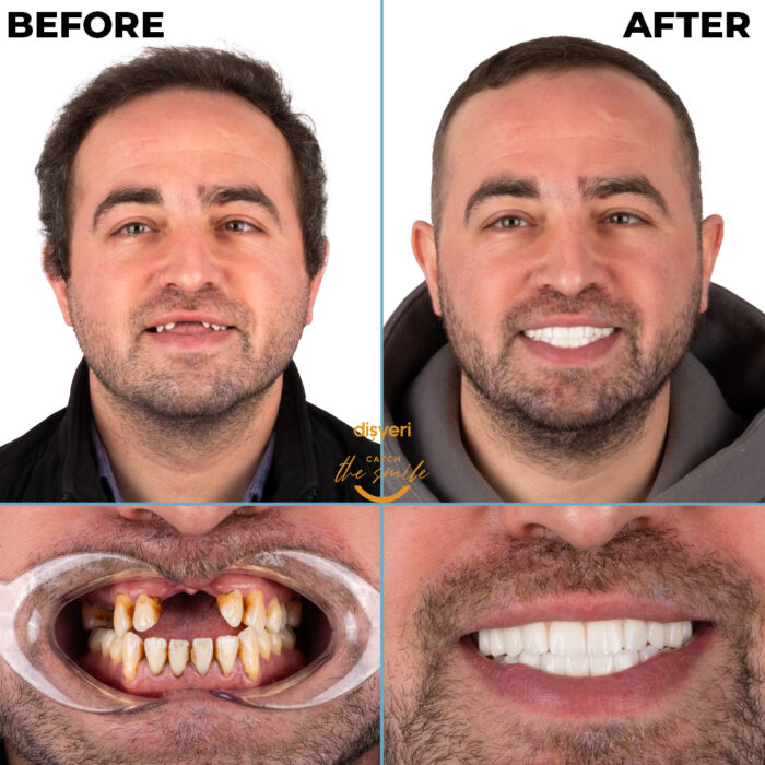 diş tedavisi dişyeri grup mecidiyeköy gülüş tasarımı implant zirkonyum-4