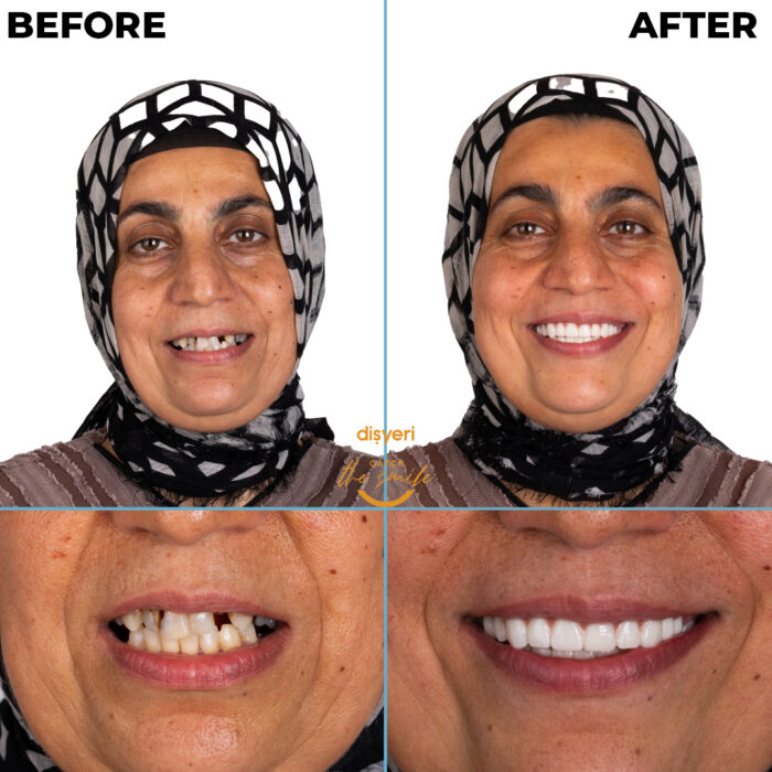 diş tedavisi dişyeri grup mecidiyeköy gülüş tasarımı implant zirkonyum-5
