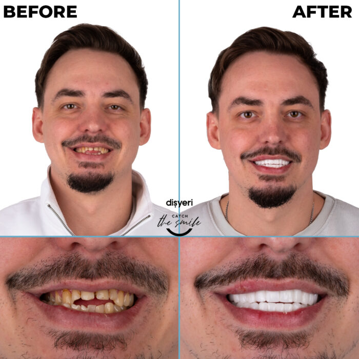 diş tedavisi dişyeri grup mecidiyeköy gülüş tasarımı implant zirkonyum-6