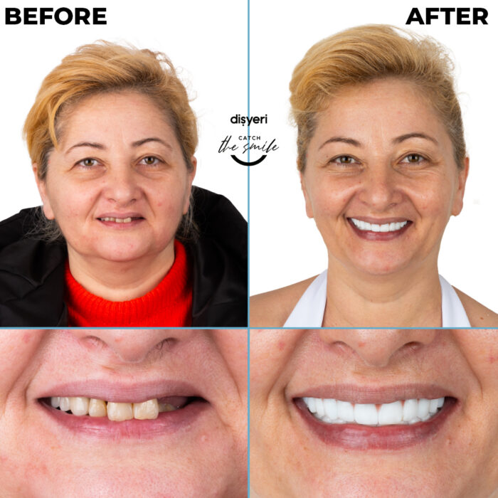 diş tedavisi dişyeri grup mecidiyeköy gülüş tasarımı implant zirkonyum-7