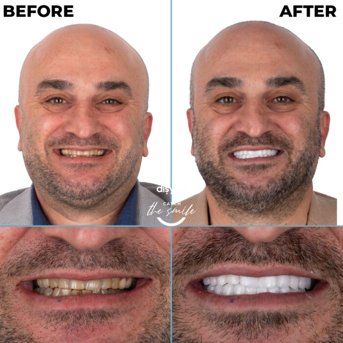 diş tedavisi dişyeri grup mecidiyeköy gülüş tasarımı implant zirkonyum-8