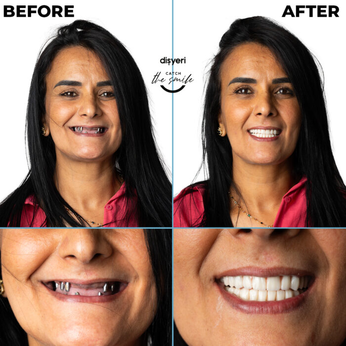 diş tedavisi dişyeri grup mecidiyeköy gülüş tasarımı implant zirkonyum-9