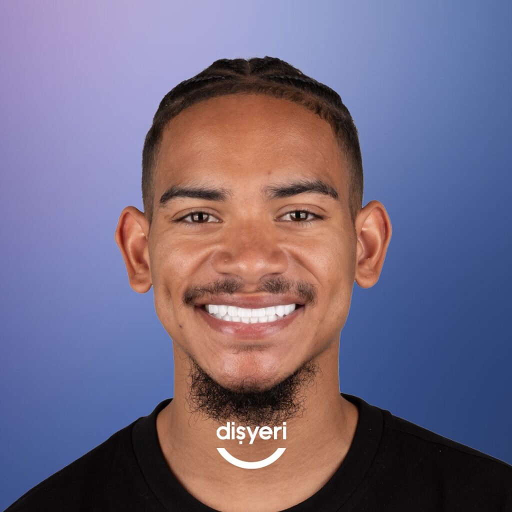 facettes dentaires en Turquie-2