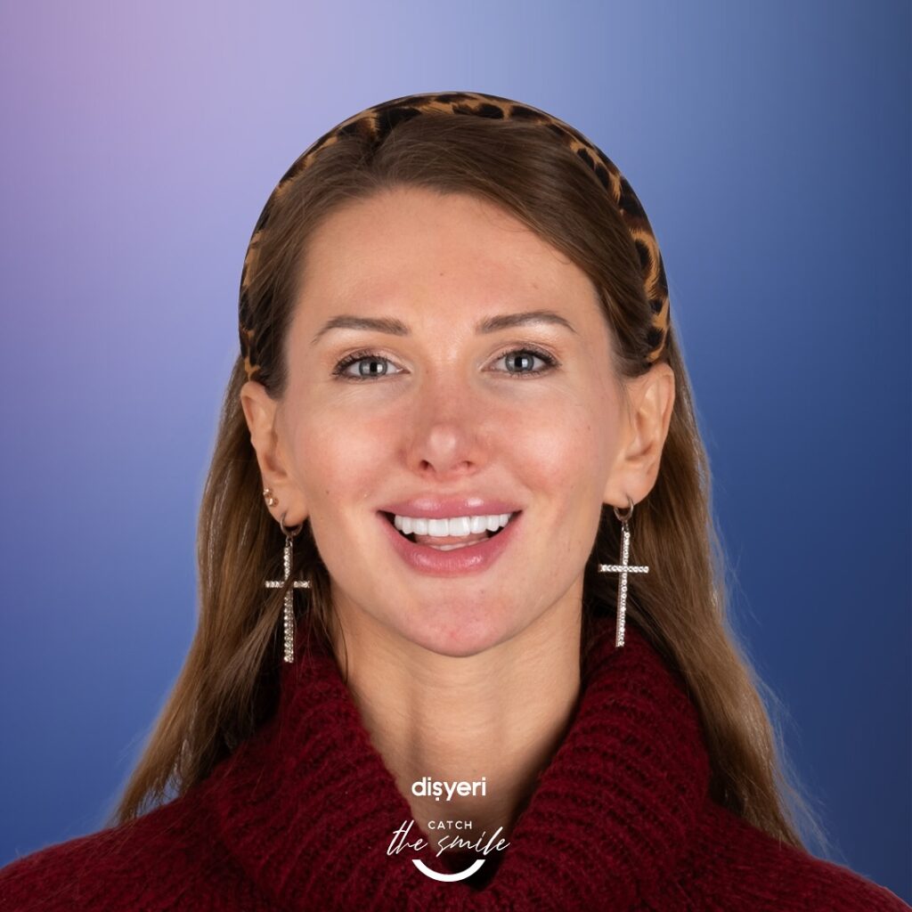 facettes dentaires en Turquie-4